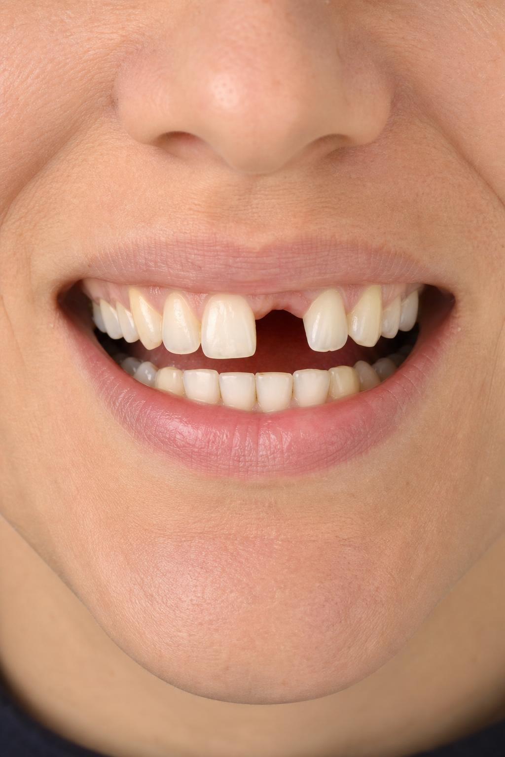 Before dental treatment 1